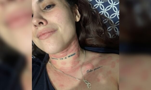 De comezón a ronchas en todo el cuerpo: Fernanda denuncia grave urticaria por agua contaminada en Guadalajara